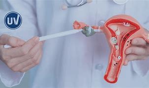 Fibroid Treatment