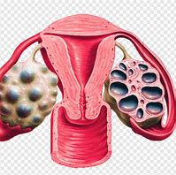 Ovarian Cyst
